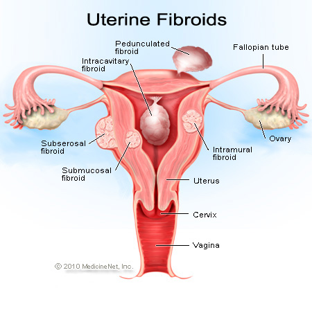 This is what it looked like when my fibroids were growing in my uterine wall.